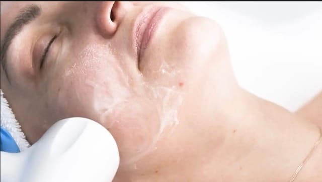 Alma Accent Prime facial tightening treatment