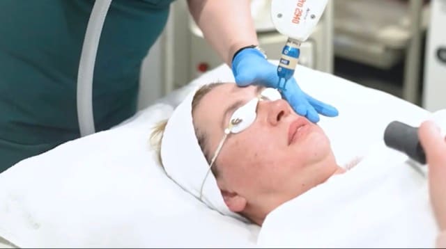 Alma Pixel fractional laser treatment