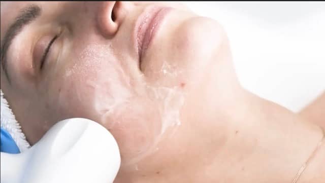 Alma Accent Prime facial tightening treatment