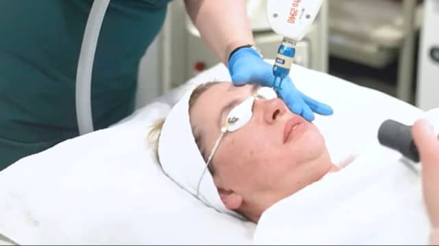 Alma Pixel fractional laser treatment