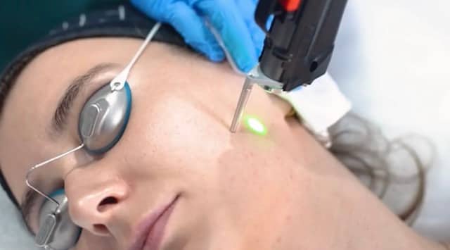 Cynosure Elite iQ laser treatment