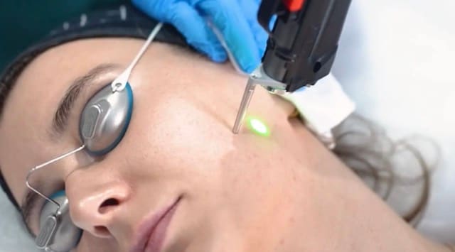 Cynosure Elite iQ laser treatment