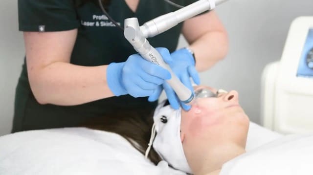 PicoWay Resolve laser treatment at Profile
