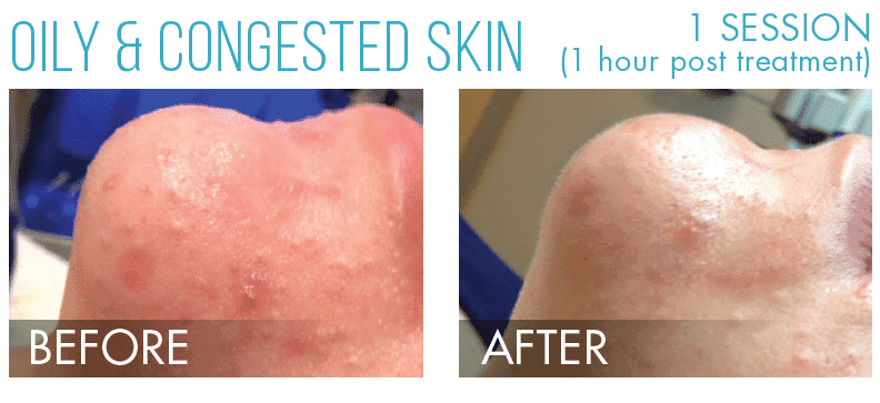 Bela MD+ facial treatment