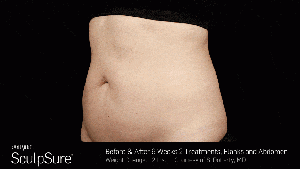 What Is Body Sculpting? Why You Should Consider It!