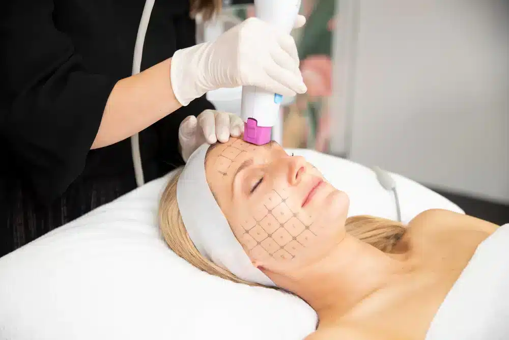 Fotona SP Dynamis hair restoration and scalp treatments
