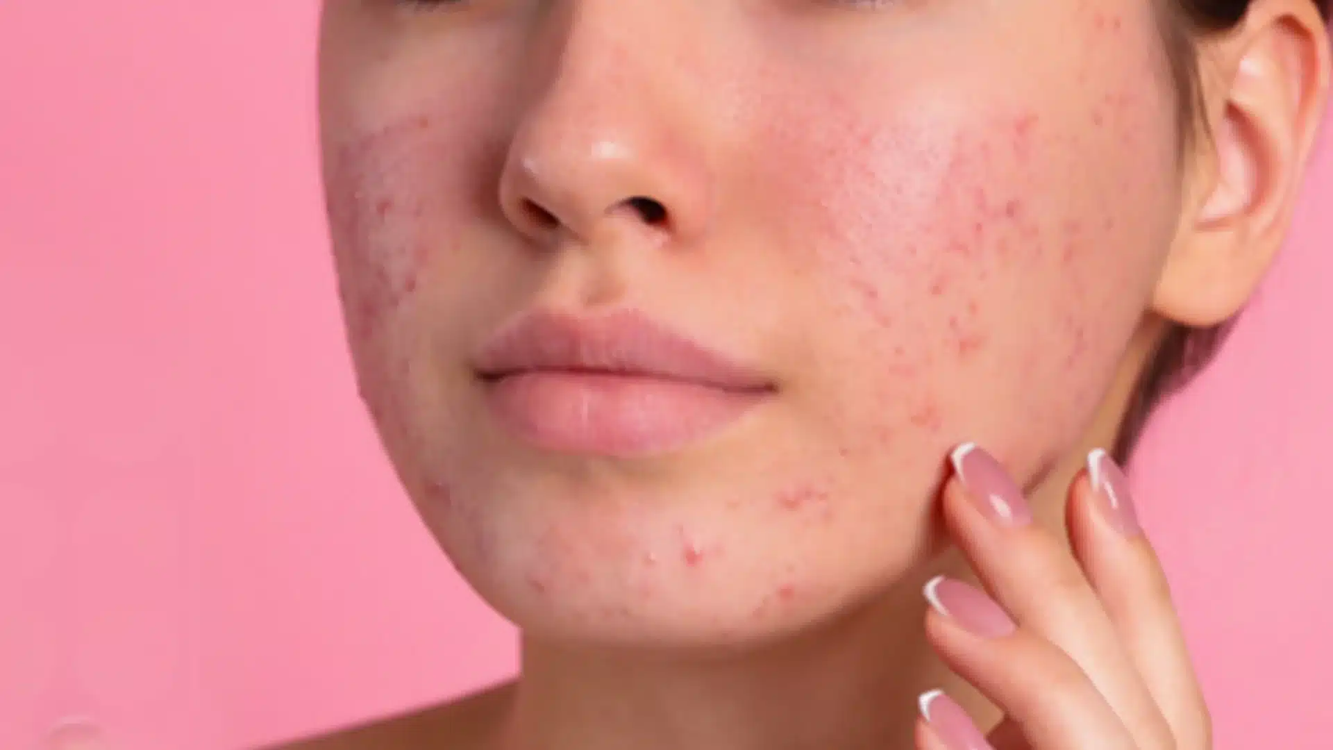 How to get rid of acne scars?