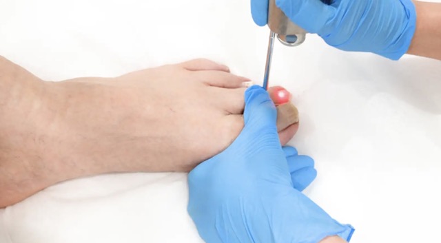 Fotona laser handpiece treatment