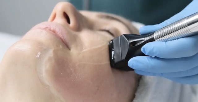 InMode facial radiofrequency treatment