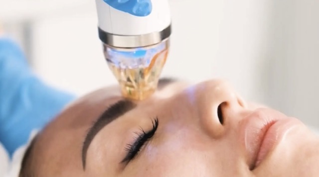 Secret PRO RF microneedling treatment